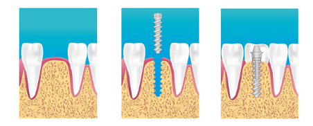 implant dentaire les lilas