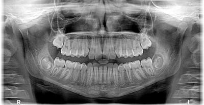 panoramique dentaire - dentiste les lilas