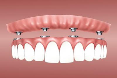 implant dentaire les lilas